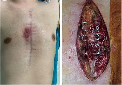 Deep sternal wound infection and pectoralis major muscle flap reconstruction: A single-center 20-year retrospective study